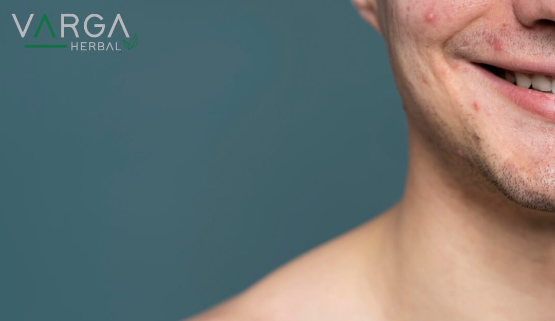 Aknés Bőr: Tippek és Trükkök a Bőrápoláshoz